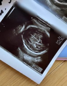 Usg w ciąży a prawo do informacji